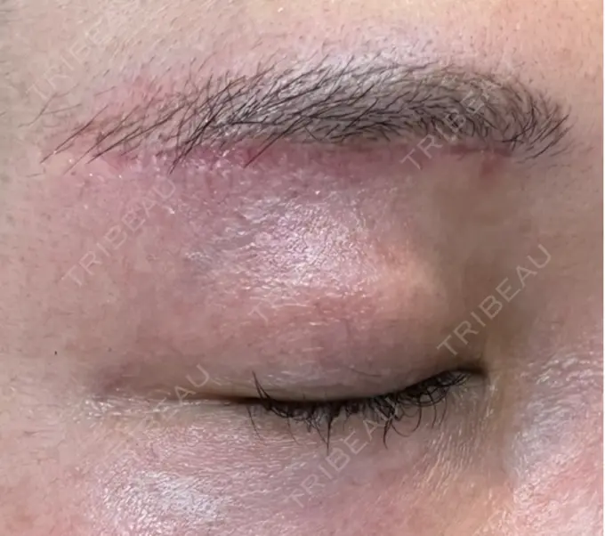 上まぶたの脂肪取り / 眉下切開 / ボトックス（眉間） THE FIRST CLINIC 多摩センター院 DAY 201 メイン用