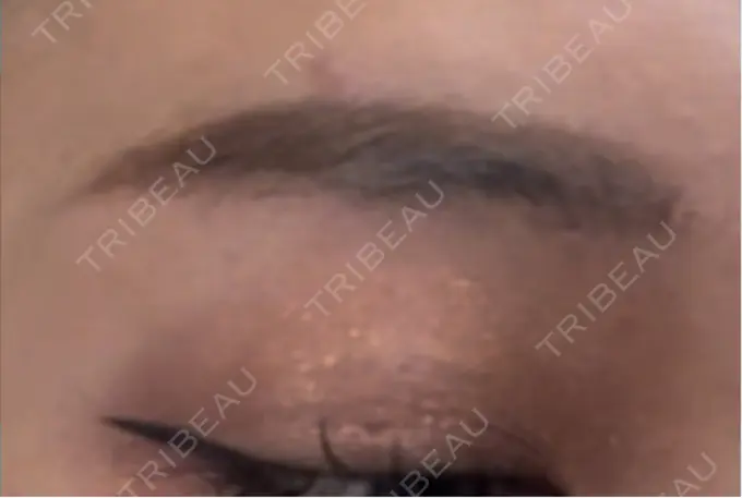 上まぶたの脂肪取り / 眉下切開 / ボトックス（眉間） THE FIRST CLINIC 多摩センター院 DAY 269 メイン用