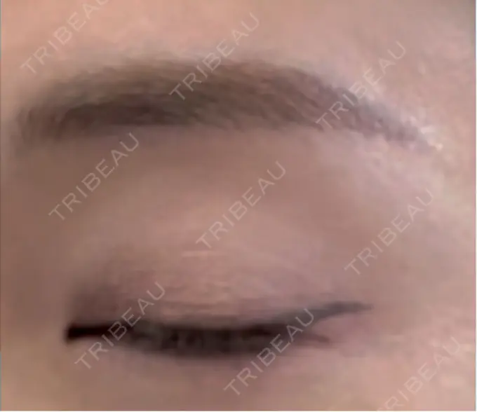 上まぶたの脂肪取り / 眉下切開 / ボトックス（眉間） THE FIRST CLINIC 多摩センター院 DAY 269 メイン用