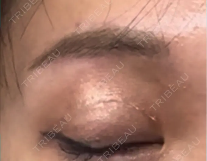 上まぶたの脂肪取り / 眉下切開 / ボトックス（眉間） THE FIRST CLINIC 多摩センター院 DAY 324 メイン用