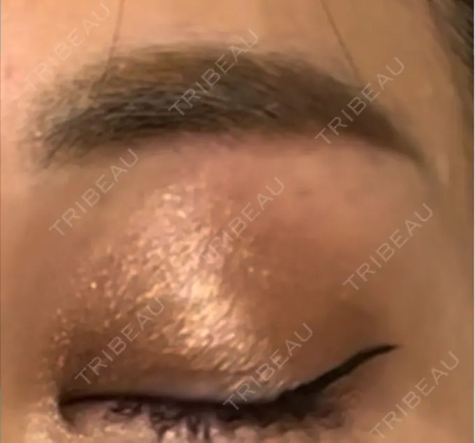 上まぶたの脂肪取り / 眉下切開 / ボトックス（眉間） THE FIRST CLINIC 多摩センター院 DAY 324 メイン用