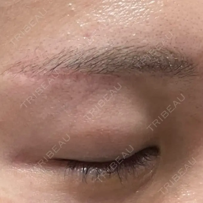 上まぶたの脂肪取り / 眉下切開 / ボトックス（眉間） THE FIRST CLINIC 多摩センター院 AFTER メイン用