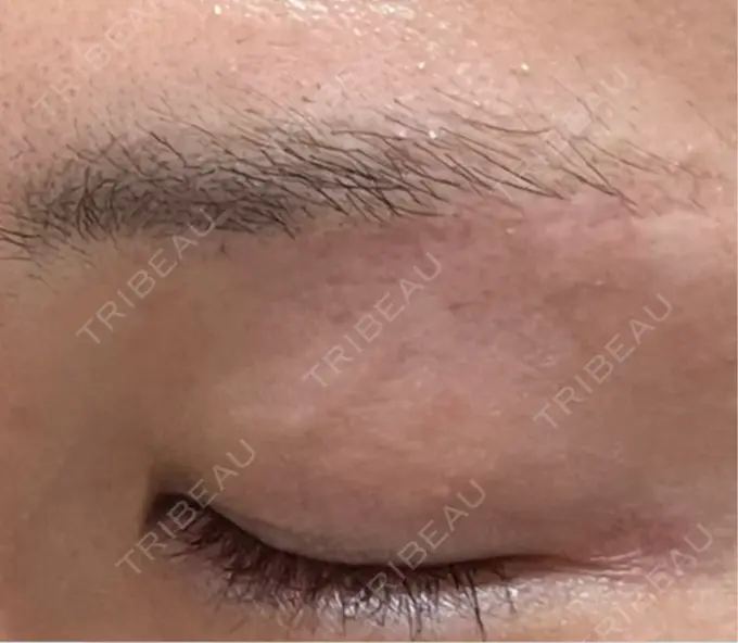 上まぶたの脂肪取り / 眉下切開 / ボトックス（眉間） THE FIRST CLINIC 多摩センター院 DAY 329 メイン用