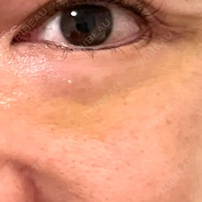 ボトックス（タレ目） MKクリニック 銀座院 DAY 8 メイン用