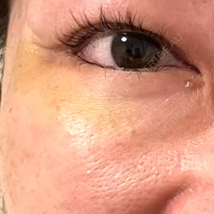 ボトックス（タレ目） MKクリニック 銀座院 DAY 9 メイン用