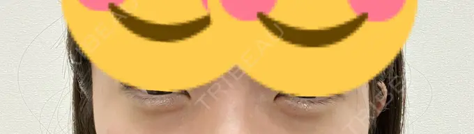 ヒアルロン酸注入（涙袋） 新未来クリニック DAY 3 メイン用