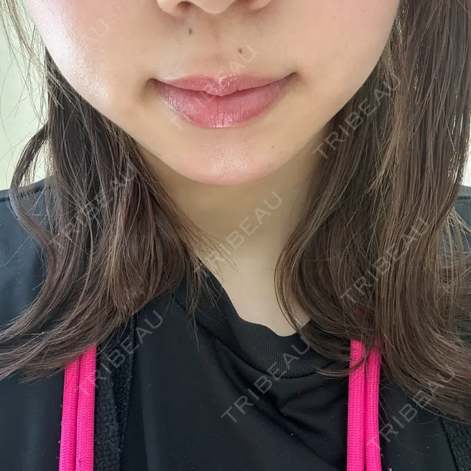 ヒアルロン酸注入（あご） フィラークリニック 名古屋栄院 DAY 11 メイン用