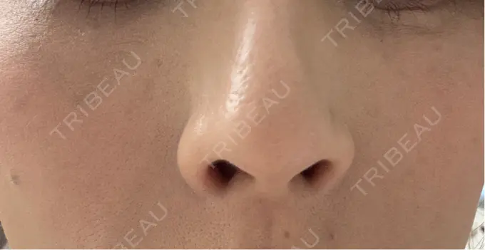 その他（肌） 美容皮膚科エルムクリニック 岡山院 DAY 7 メイン用