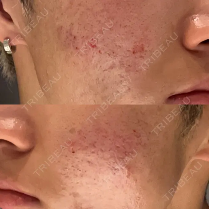 肌ヒアルロン酸注入（たるみ・シワ改善） / その他（肌） / ニキビ治療 ゆきスキンクリニック 東池袋 DAY 0 メイン用