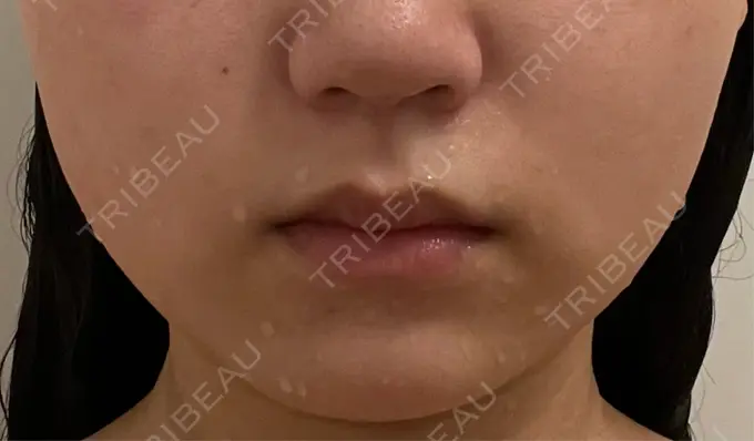 ボトックス（エラ・小顔） TCB東京中央美容外科 仙台駅前院 AFTER メイン用