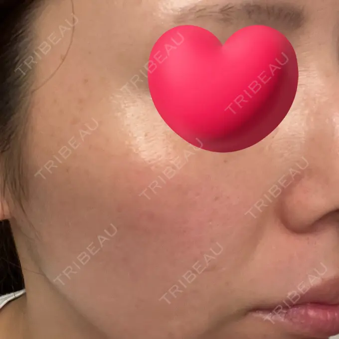 イオン導入 湘南美容クリニック 立川院 AFTER メイン用