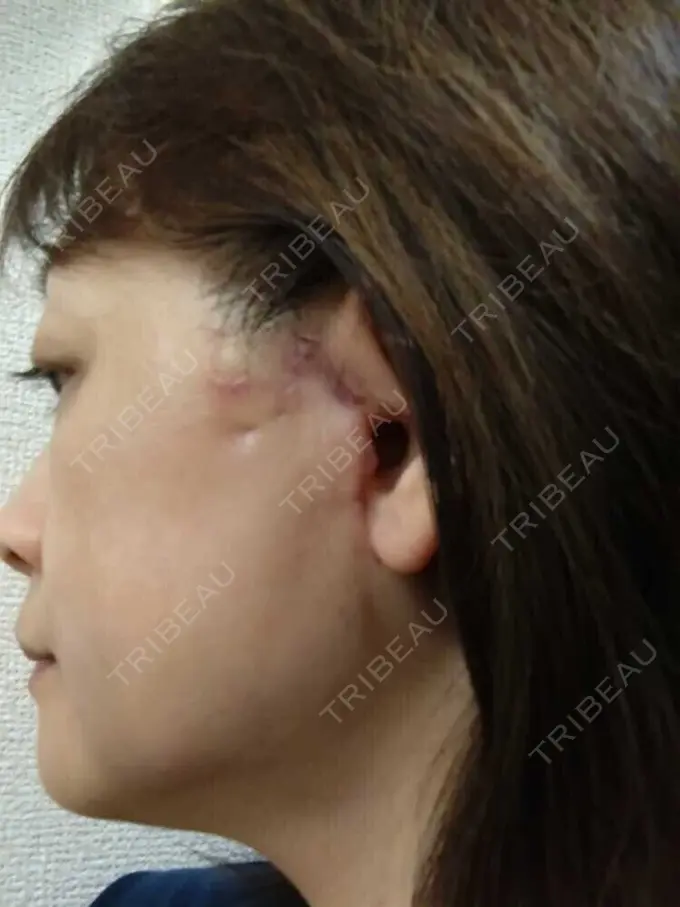 切開リフト / 肌ヒアルロン酸注入（たるみ・シワ改善） / 美肌レーザー 石倉クリニック 水戸院 DAY 30 メイン用