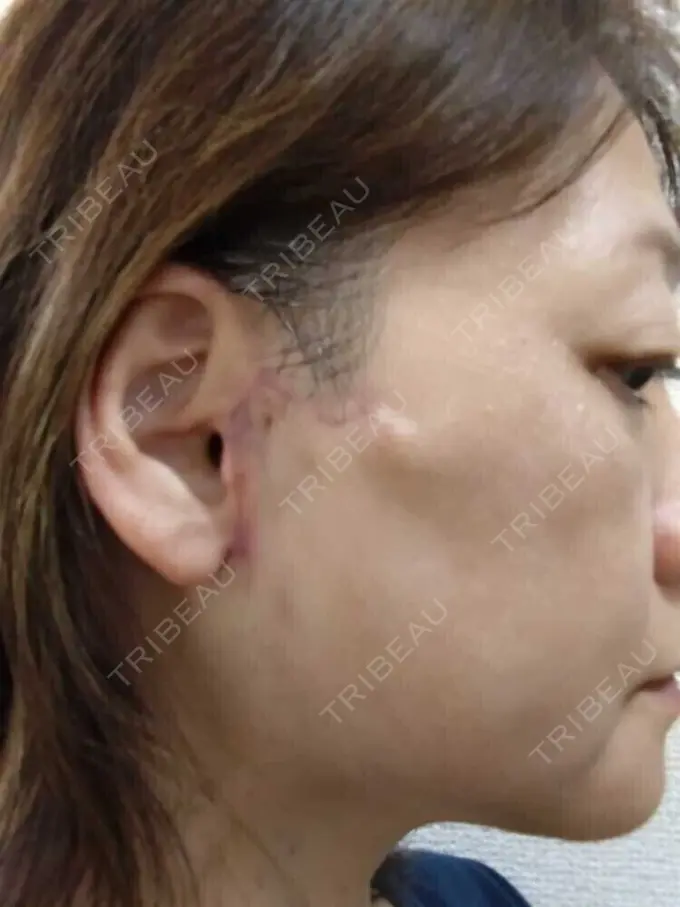 切開リフト / 肌ヒアルロン酸注入（たるみ・シワ改善） / 美肌レーザー 石倉クリニック 水戸院 DAY 30 メイン用