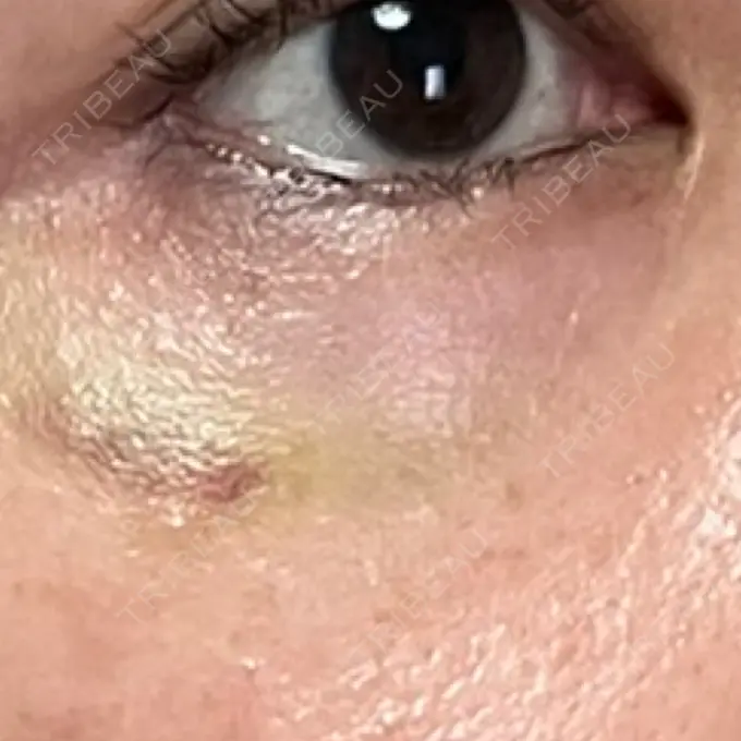 ボトックス（タレ目） MKクリニック 銀座院 DAY 6 メイン用