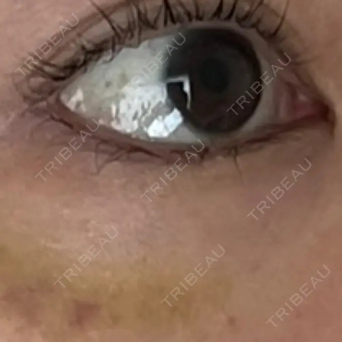 ボトックス（タレ目） MKクリニック 銀座院 DAY 7 メイン用