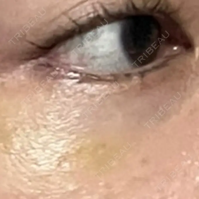 ボトックス（タレ目） MKクリニック 銀座院 DAY 11 メイン用