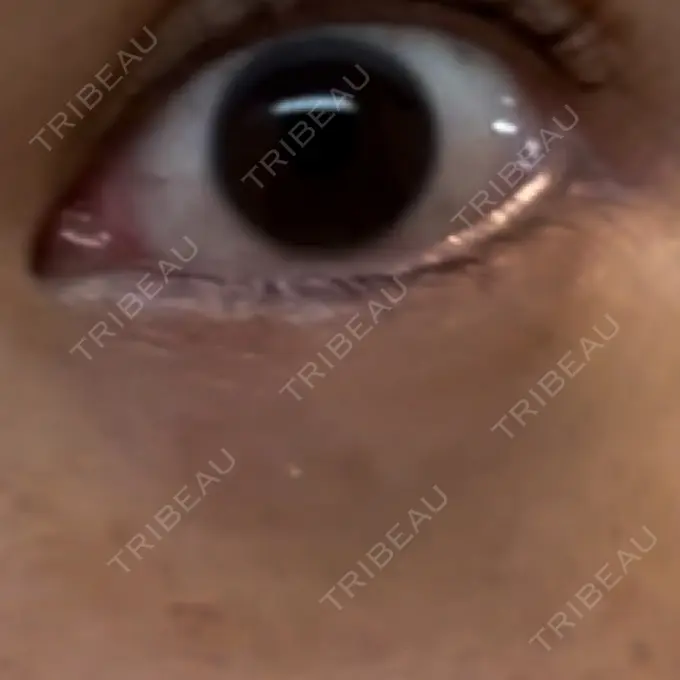 ボトックス（タレ目） MKクリニック 銀座院 AFTER メイン用