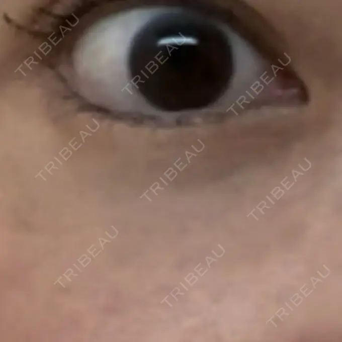 ボトックス（タレ目） MKクリニック 銀座院 DAY 16 メイン用