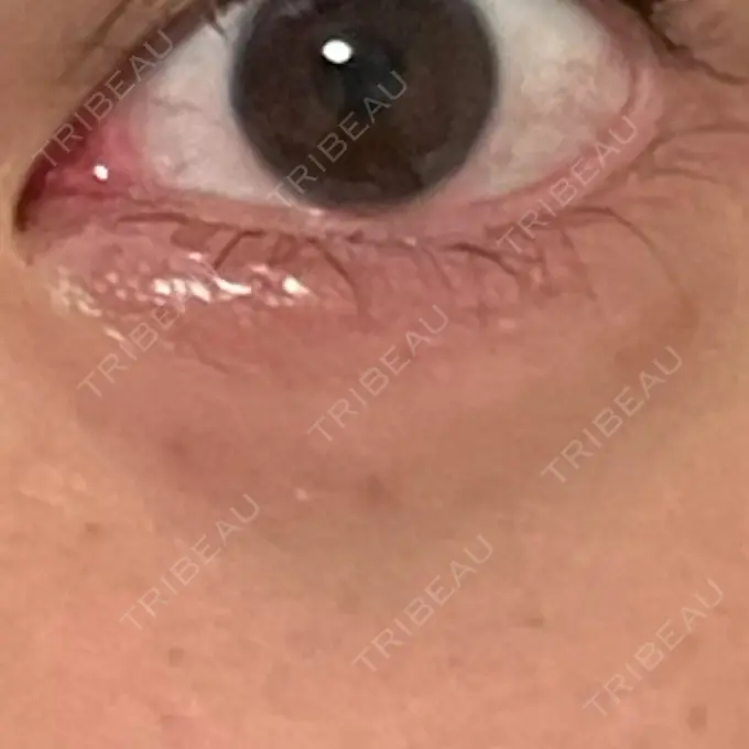 ヒアルロン酸注入（涙袋） MKクリニック 日本橋院 DAY 24 メイン用