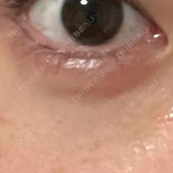 ヒアルロン酸注入（涙袋） MKクリニック 日本橋院 DAY 24 メイン用