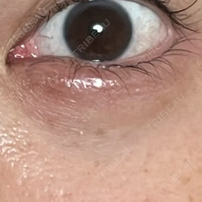 ヒアルロン酸注入（涙袋） MKクリニック 日本橋院 DAY 32 メイン用