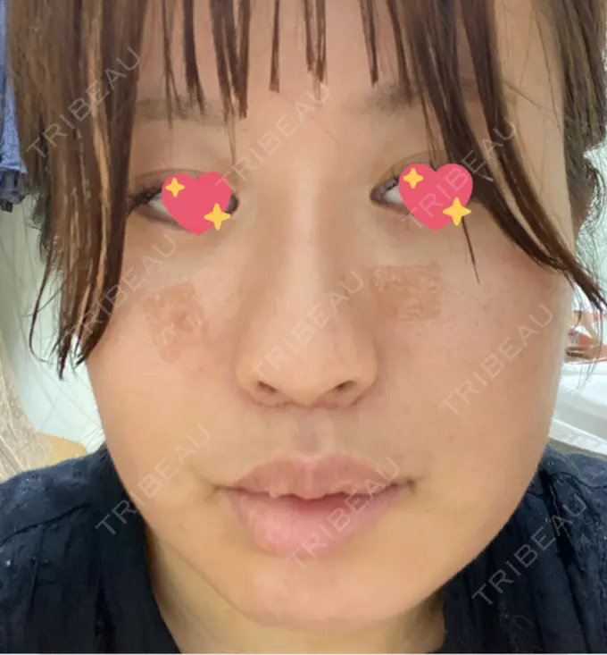 ほくろ・いぼ切除（肌） TCB東京中央美容外科 新潟院 DAY 2 メイン用