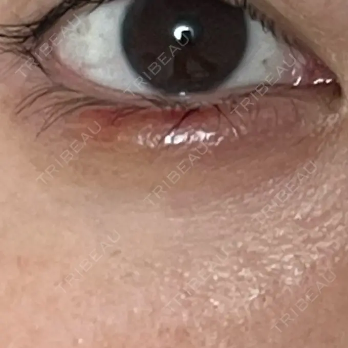 ヒアルロン酸注入（涙袋） MKクリニック 日本橋院 DAY 32 メイン用