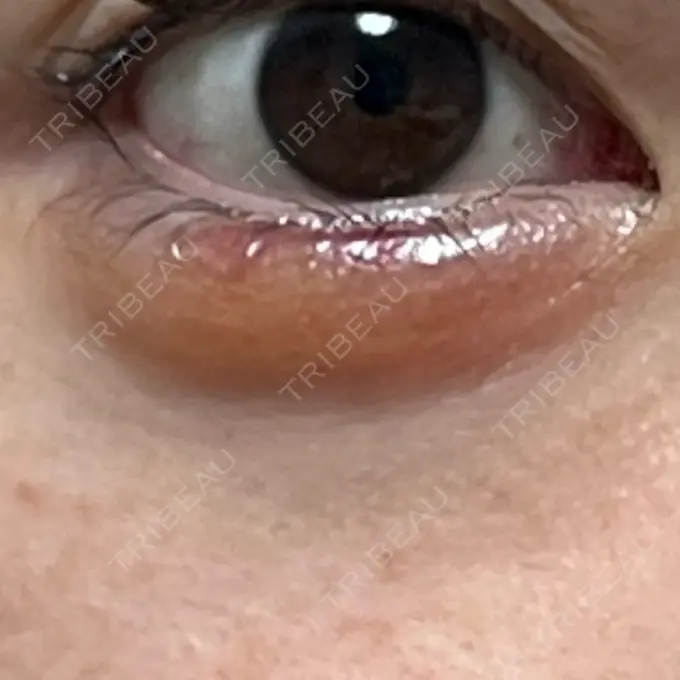 ヒアルロン酸注入（涙袋） MKクリニック 日本橋院 DAY 32 メイン用