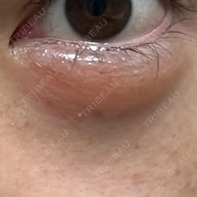 ヒアルロン酸注入（涙袋） MKクリニック 日本橋院 DAY 34 メイン用