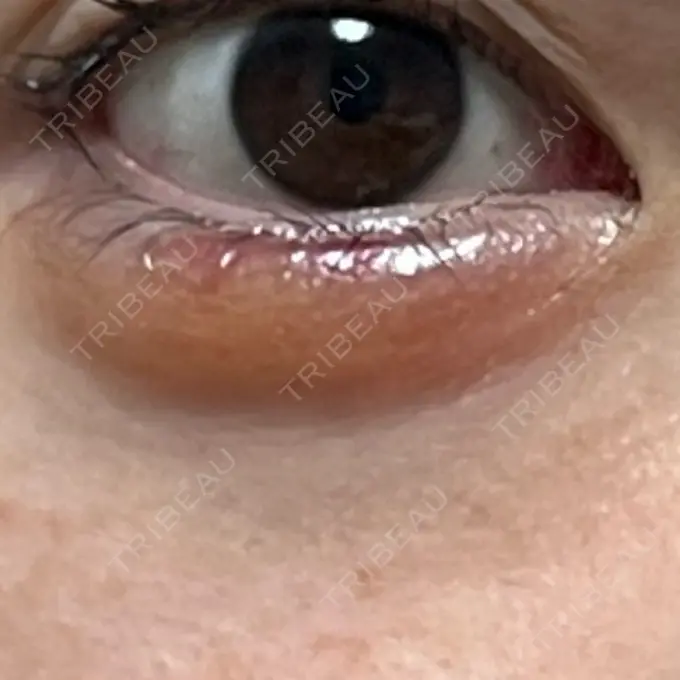 ヒアルロン酸注入（涙袋） MKクリニック 日本橋院 DAY 34 メイン用