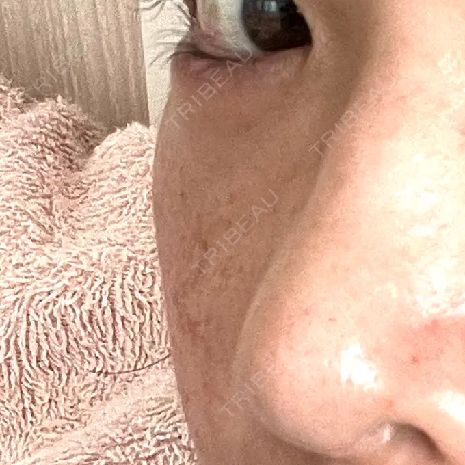 脂肪溶解注射（顔） MKクリニック 銀座院 DAY 34 メイン用