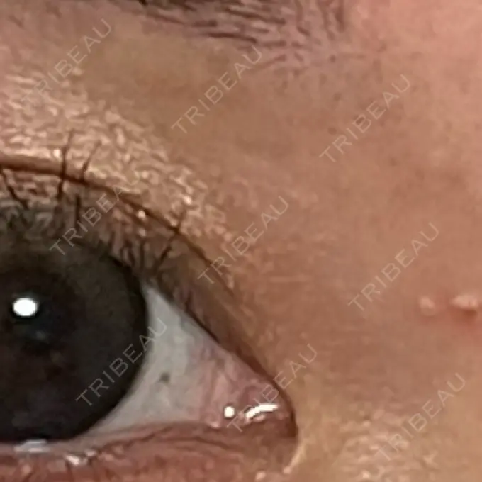 脂肪溶解注射（顔） MKクリニック 銀座院 DAY 36 メイン用