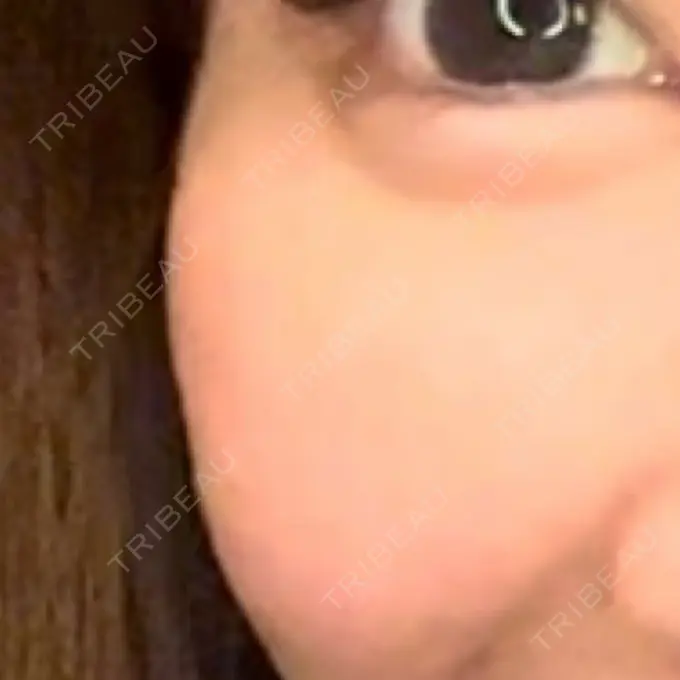 脂肪溶解注射（顔） MKクリニック 銀座院 AFTER メイン用