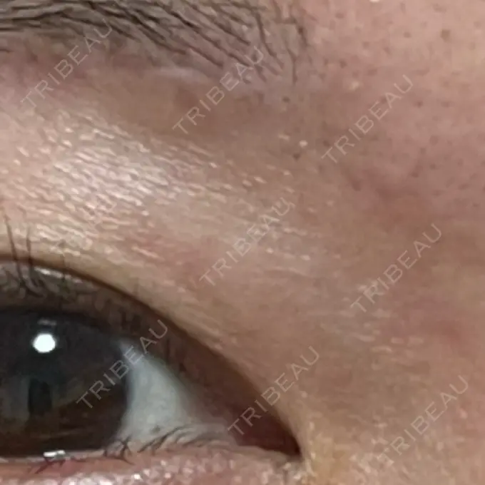 脂肪溶解注射（顔） MKクリニック 銀座院 DAY 40 メイン用