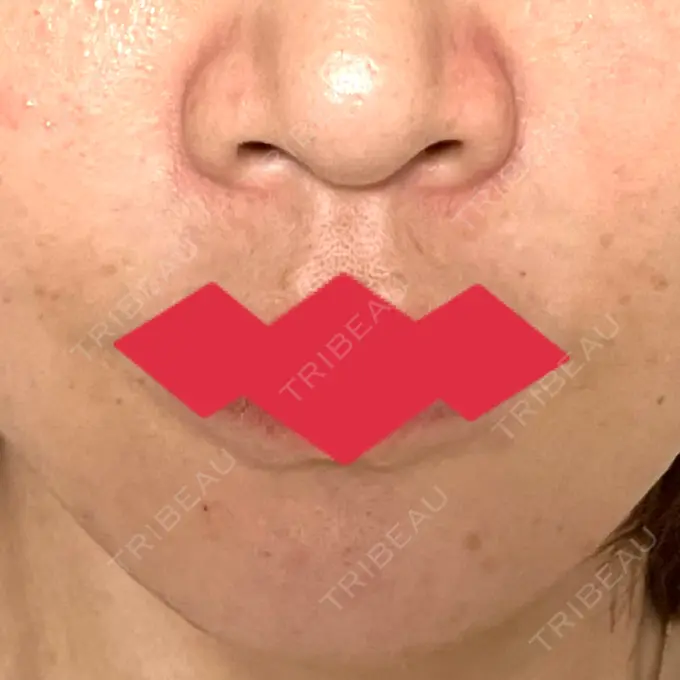 脂肪溶解注射（顔） MKクリニック 銀座院 DAY 40 メイン用