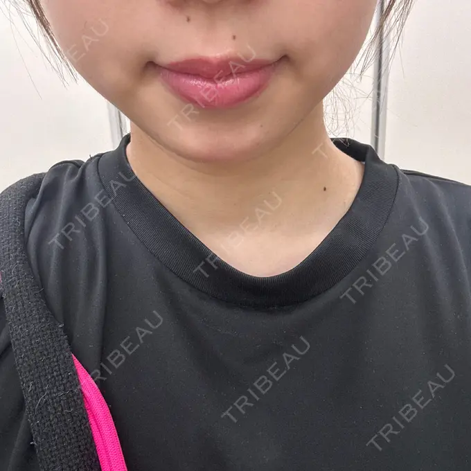 ヒアルロン酸注入（あご） フィラークリニック 名古屋栄院 DAY 12 メイン用