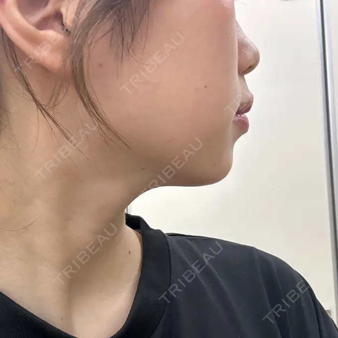 ヒアルロン酸注入（あご） フィラークリニック 名古屋栄院 DAY 12 メイン用