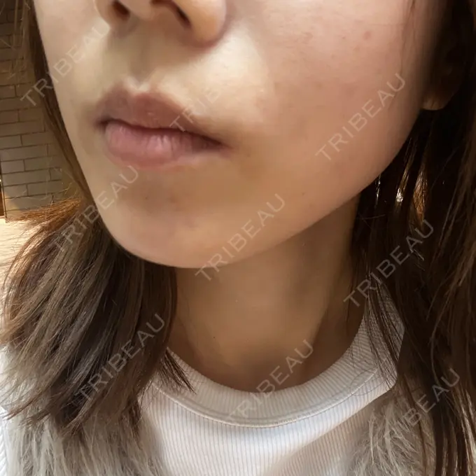 美容点滴・美容注射（美肌） / レーザートーニング（美白・肝斑） 城本クリニック 立川院 DAY 0 メイン用