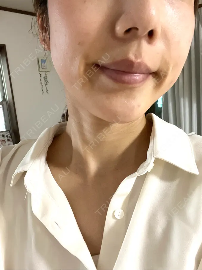 美容点滴・美容注射（美肌） / レーザートーニング（美白・肝斑） 城本クリニック 立川院 DAY 1 メイン用