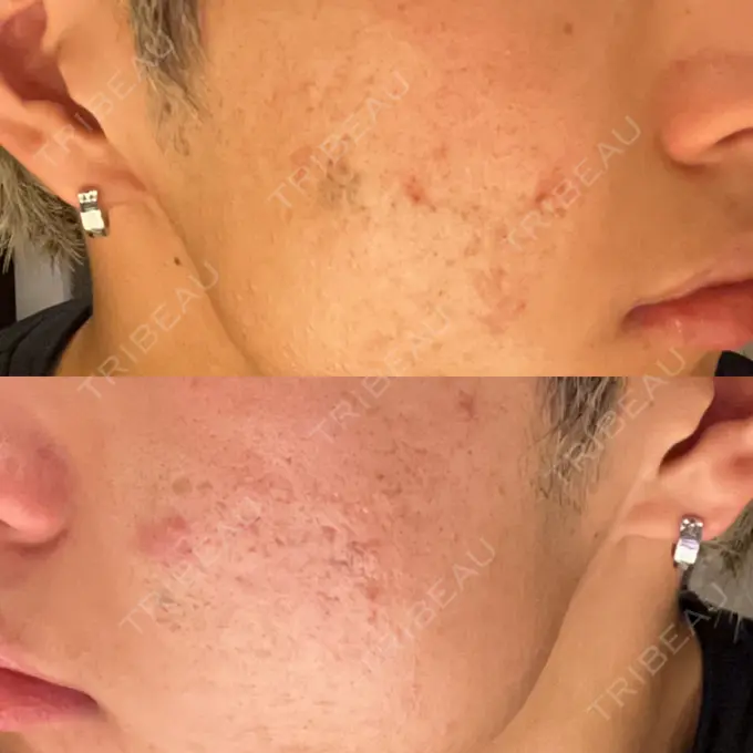 肌ヒアルロン酸注入（たるみ・シワ改善） / その他（肌） / ニキビ治療 ゆきスキンクリニック 東池袋 DAY 2 メイン用