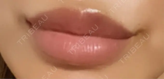 ヒアルロン酸注入（唇） 麻布十番クレールデンタルクリニック DAY 6 メイン用