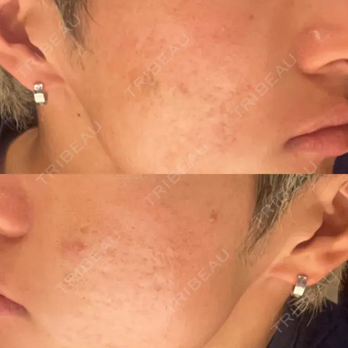 肌ヒアルロン酸注入（たるみ・シワ改善） / その他（肌） / ニキビ治療 ゆきスキンクリニック 東池袋 DAY 3 メイン用