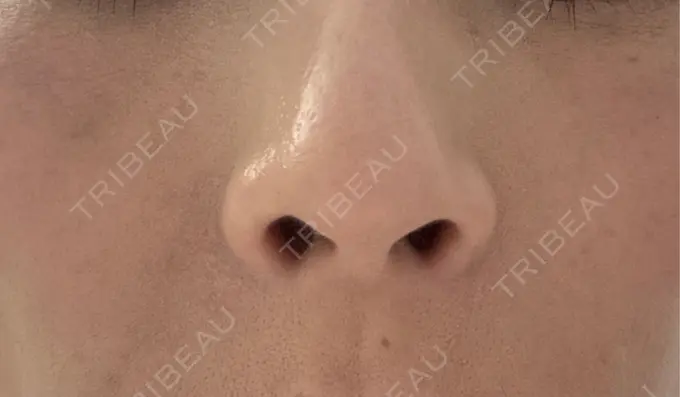 その他（肌） 美容皮膚科エルムクリニック 岡山院 DAY 11 メイン用