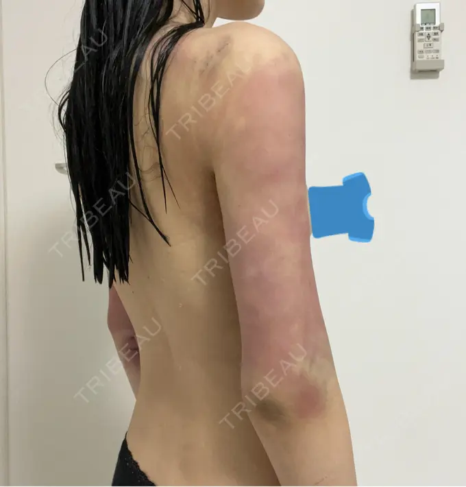 脂肪吸引（二の腕） 4Dクリニック DAY 3 メイン用