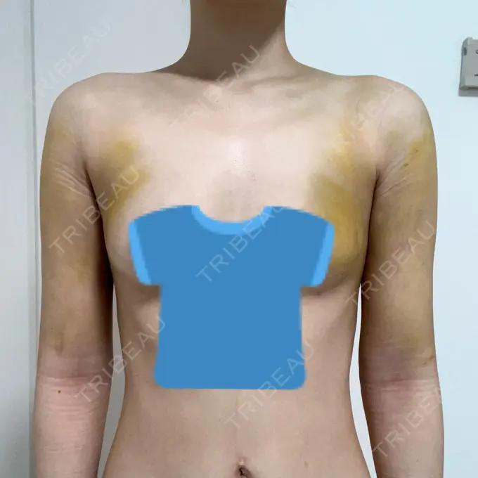 脂肪吸引（二の腕） 4Dクリニック DAY 5 メイン用