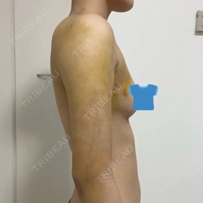 脂肪吸引（二の腕） 4Dクリニック DAY 5 メイン用