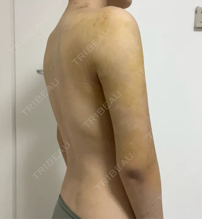 脂肪吸引（二の腕） 4Dクリニック DAY 5 メイン用