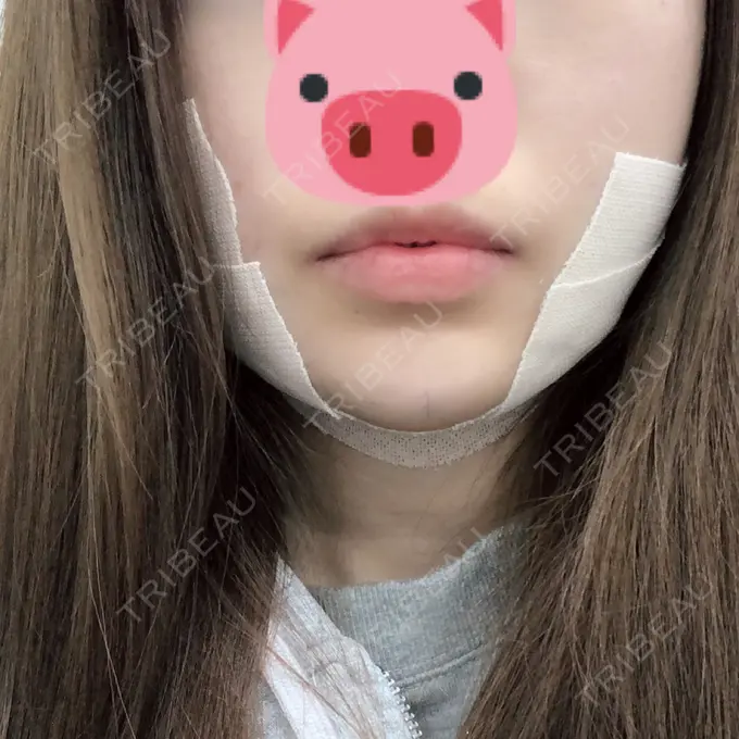 バッカルファット除去 / 脂肪吸引（顔） / 目尻切開 / 水光注射（ハリ・美肌） / ヒアルロン酸注入（あご） / ボトックス（エラ・小顔） / ボトックス（口角） / 白玉点滴・注射 / その他（肌） エートップ美容整形外科 DAY 0 メイン用