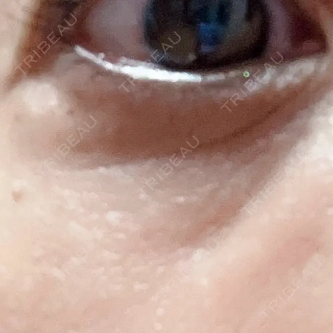 水光注射（ハリ・美肌） / ボトックス（額） 品川美容外科 名古屋院 AFTER メイン用