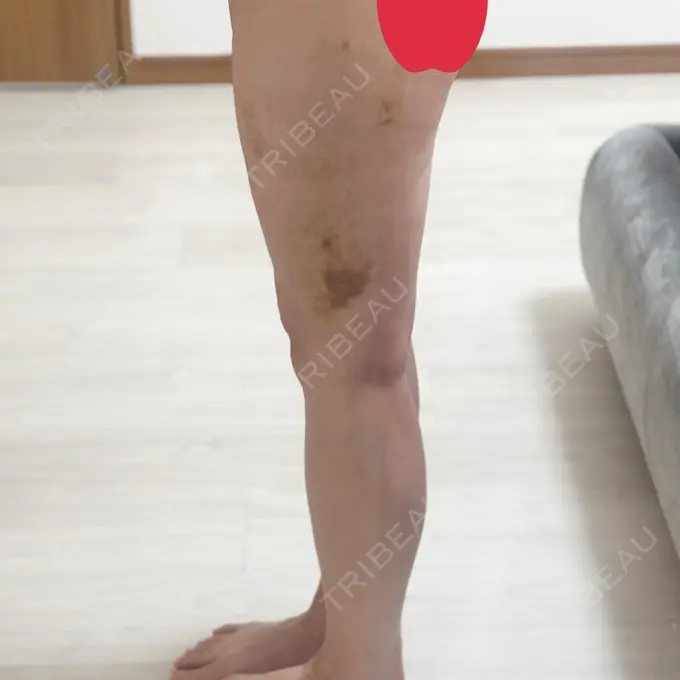 脂肪吸引（脚） / 豊胸（シリコンバッグ） / 脂肪冷却（太もも） / ワキ汗治療（ボトックス） MYCLI【マイクリ】東京・恵比寿院 DAY 17 メイン用